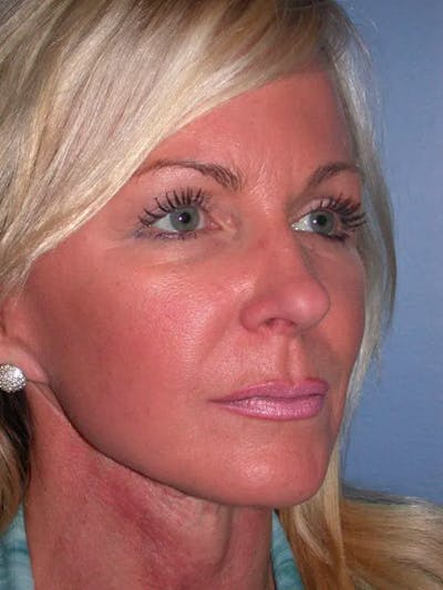 Cheek Lift Gallery Before & After Gallery - Patient 5900606 - Image 8