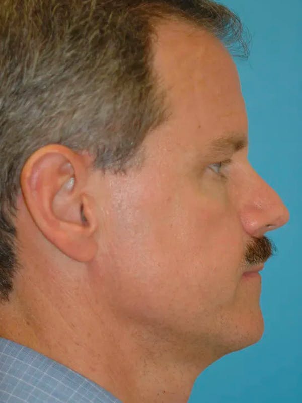 Eyelid Lift Gallery Before & After Gallery - Patient 4756913 - Image 3