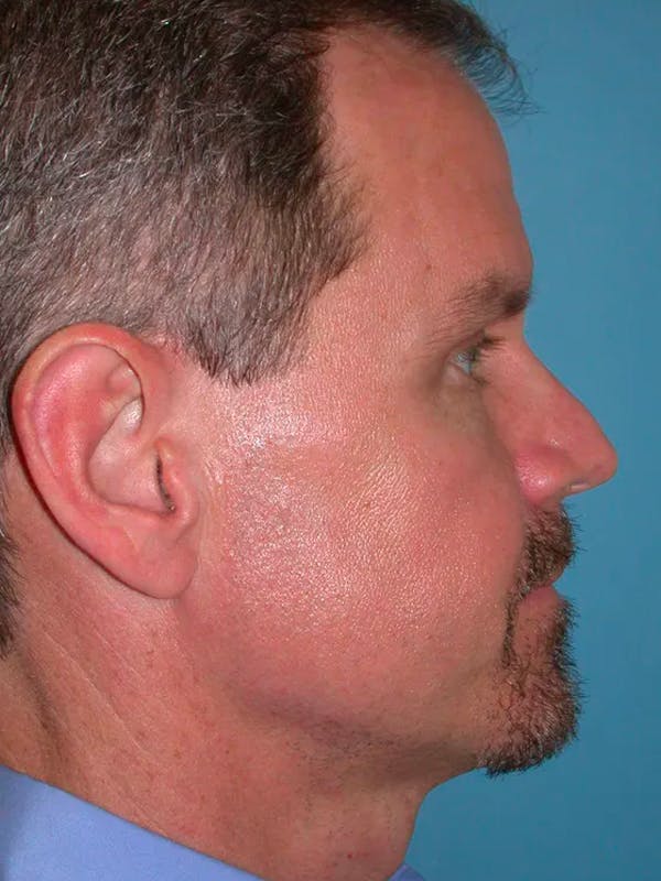 Eyelid Lift Gallery Before & After Gallery - Patient 4756913 - Image 4