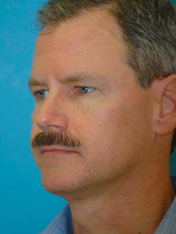 Eyelid Lift Gallery Before & After Gallery - Patient 4756913 - Image 5