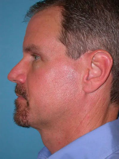 Eyelid Lift Gallery Before & After Gallery - Patient 4756913 - Image 6
