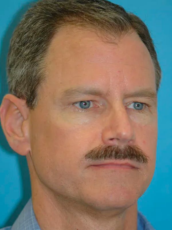 Eyelid Lift Gallery Before & After Gallery - Patient 4756913 - Image 7