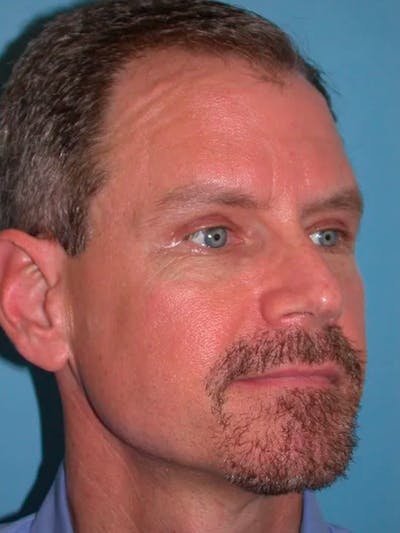Eyelid Lift Gallery Before & After Gallery - Patient 4756913 - Image 8