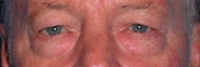 Eyelid Lift Gallery Before & After Gallery - Patient 4756962 - Image 1