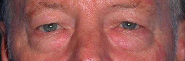 Eyelid Lift Gallery Before & After Gallery - Patient 4756962 - Image 1