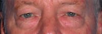 Eyelid Lift Before & After Gallery - Patient 4756962 - Image 1