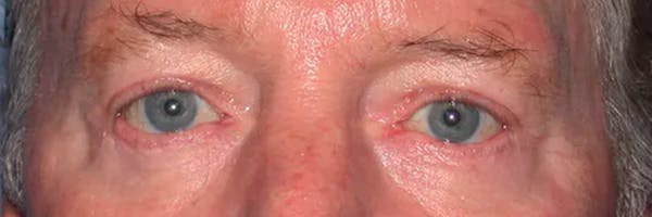 Eyelid Lift Before & After Gallery - Patient 4756962 - Image 2