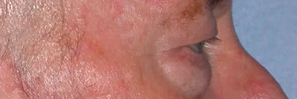Eyelid Lift Gallery Before & After Gallery - Patient 4756962 - Image 3