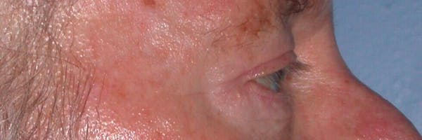 Eyelid Lift Before & After Gallery - Patient 4756962 - Image 4