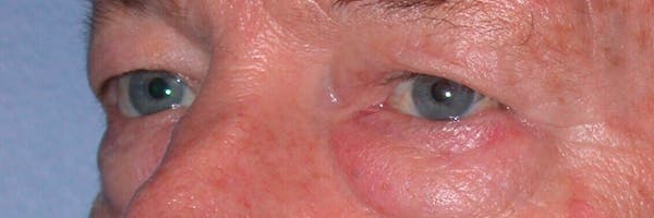 Eyelid Lift Before & After Gallery - Patient 4756962 - Image 5