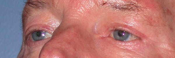 Eyelid Lift Before & After Gallery - Patient 4756962 - Image 6