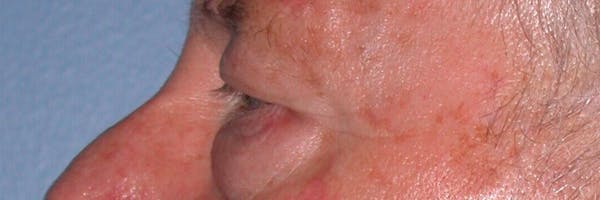 Eyelid Lift Before & After Gallery - Patient 4756962 - Image 7