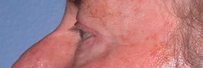 Eyelid Lift Gallery Before & After Gallery - Patient 4756962 - Image 8