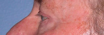 Eyelid Lift Before & After Gallery - Patient 4756962 - Image 8