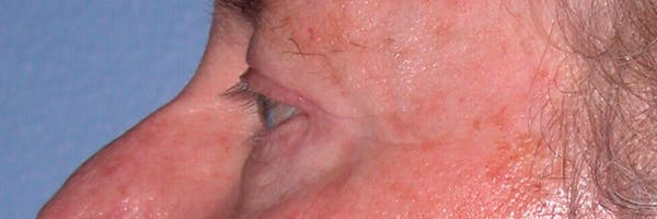Eyelid Lift Before & After Gallery - Patient 4756962 - Image 8