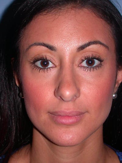 Eyelid Lift Gallery Before & After Gallery - Patient 4756919 - Image 2
