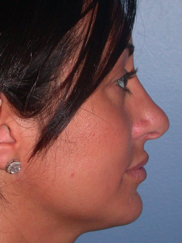 Eyelid Lift Gallery Before & After Gallery - Patient 4756919 - Image 3
