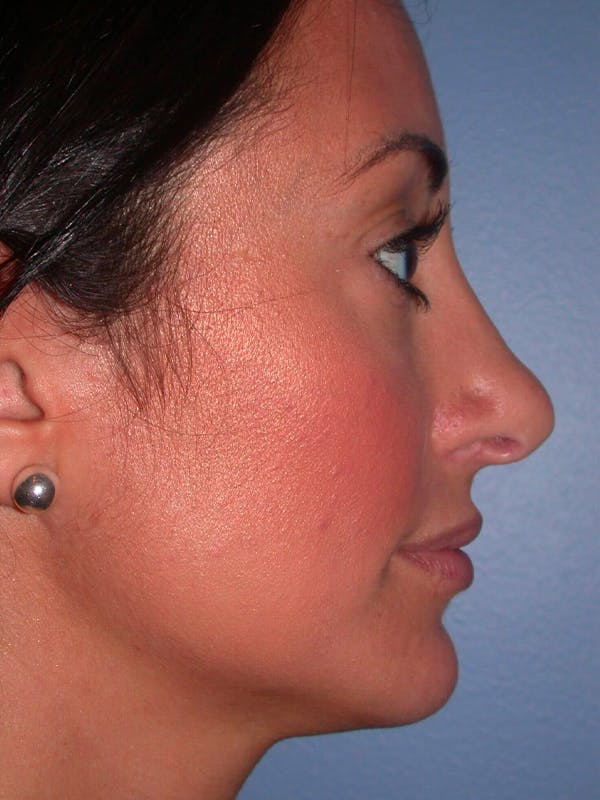 Eyelid Lift Gallery Before & After Gallery - Patient 4756919 - Image 4