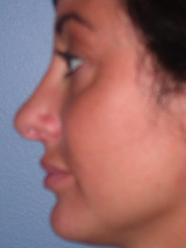 Eyelid Lift Before & After Gallery - Patient 4756919 - Image 5