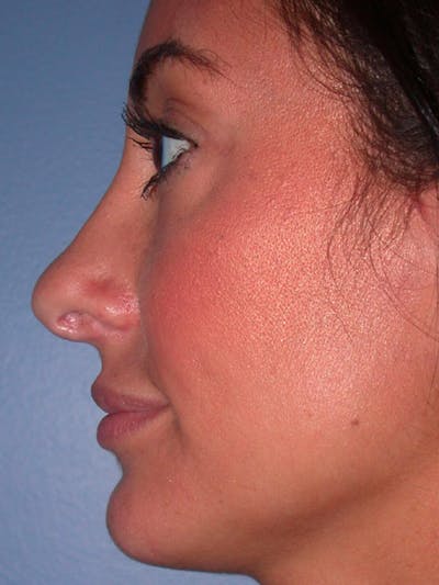 Eyelid Lift Before & After Gallery - Patient 4756919 - Image 6