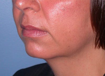 Chin Augmentation Gallery Before & After Gallery - Patient 4756932 - Image 1