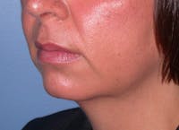 Chin Augmentation Before & After Gallery - Patient 4756932 - Image 1