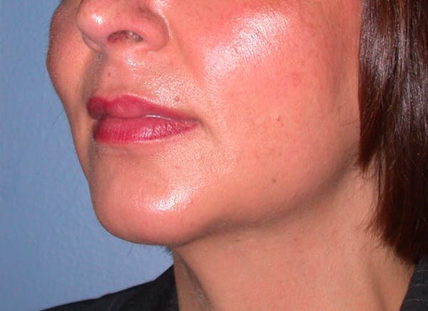 Chin Augmentation Before & After Gallery - Patient 4756932 - Image 2