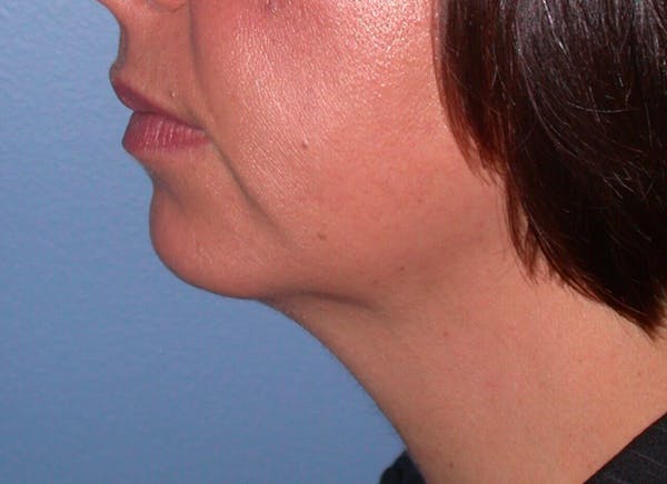 Chin Augmentation Gallery Before & After Gallery - Patient 4756932 - Image 3
