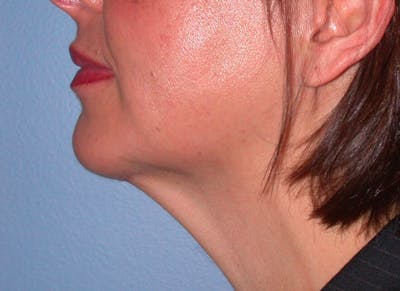 Chin Augmentation Gallery Before & After Gallery - Patient 4756932 - Image 4