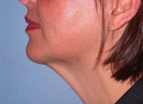 Chin Augmentation Before & After Gallery - Patient 4756932 - Image 4