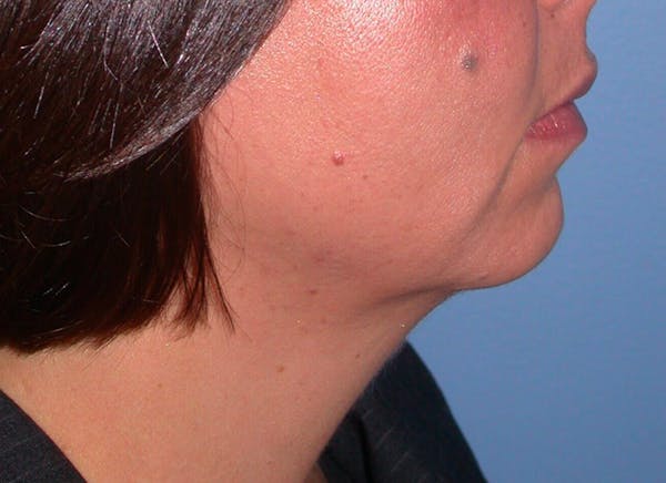 Chin Augmentation Gallery Before & After Gallery - Patient 4756932 - Image 5