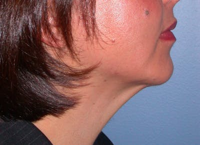 Chin Augmentation Gallery Before & After Gallery - Patient 4756932 - Image 6