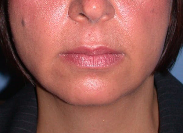 Chin Augmentation Gallery Before & After Gallery - Patient 4756932 - Image 7