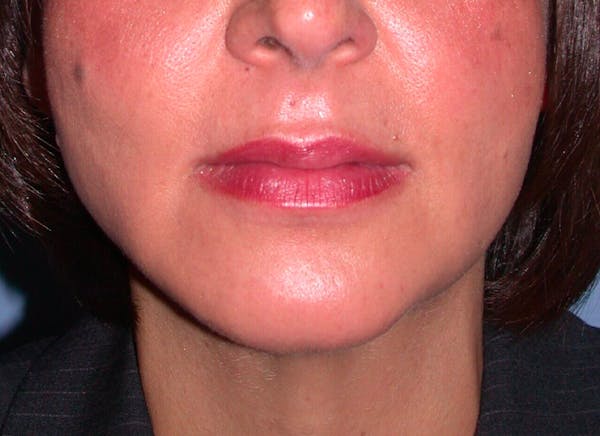 Chin Augmentation Before & After Gallery - Patient 4756932 - Image 8