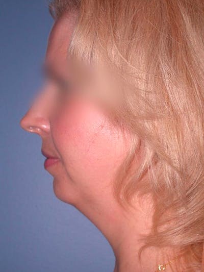 Chin Augmentation Gallery Before & After Gallery - Patient 5900638 - Image 1