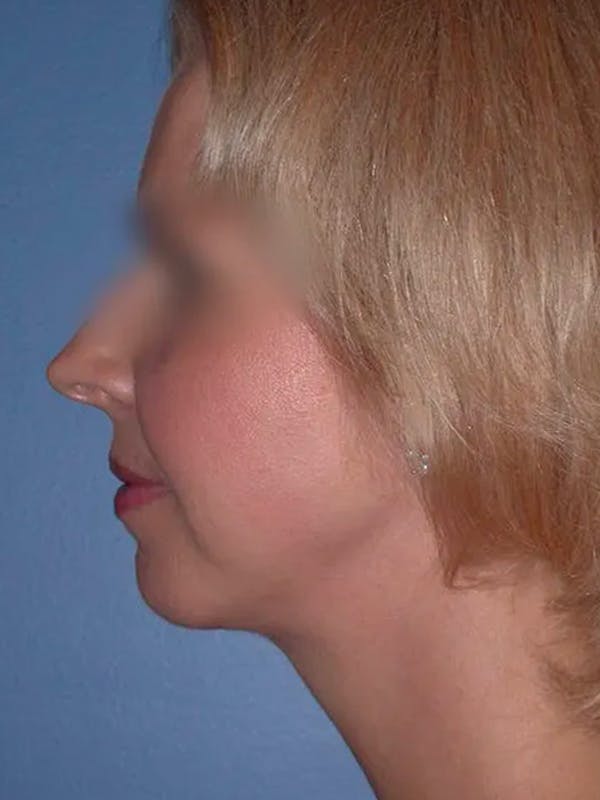 Chin Augmentation Gallery Before & After Gallery - Patient 5900638 - Image 2