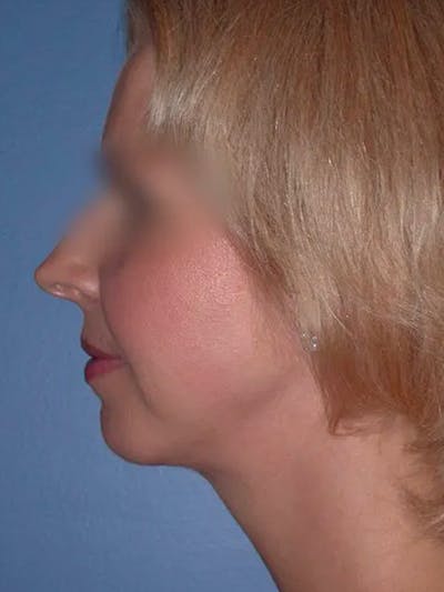 Chin Augmentation Before & After Gallery - Patient 5900638 - Image 2
