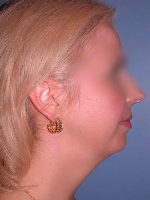 Chin Augmentation Gallery Before & After Gallery - Patient 5900638 - Image 3