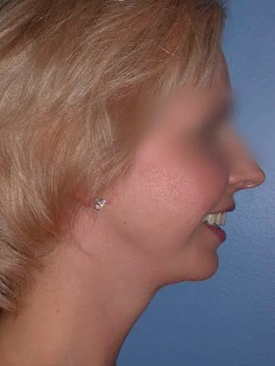 Chin Augmentation Gallery Before & After Gallery - Patient 5900638 - Image 4