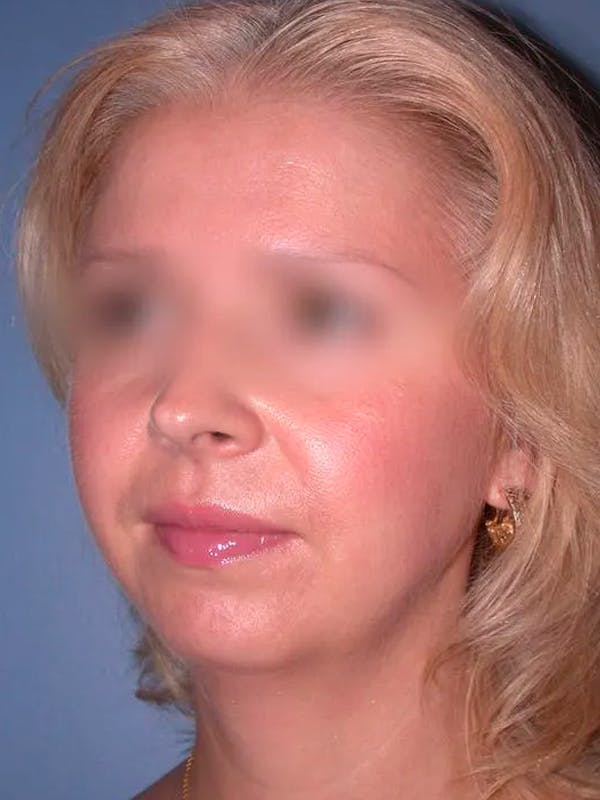 Chin Augmentation Gallery Before & After Gallery - Patient 5900638 - Image 5