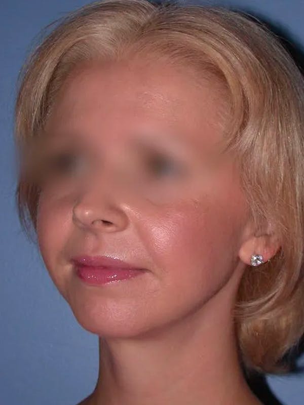 Chin Augmentation Gallery Before & After Gallery - Patient 5900638 - Image 6