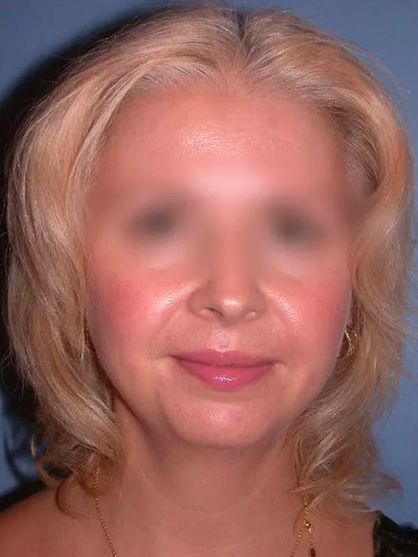 Chin Augmentation Before & After Gallery - Patient 5900638 - Image 7