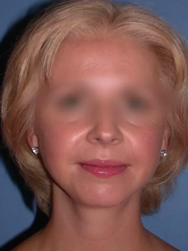 Chin Augmentation Before & After Gallery - Patient 5900638 - Image 8