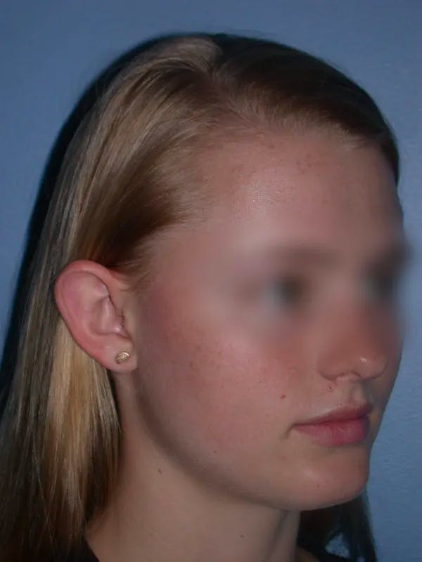 Ear Surgery Before & After Gallery - Patient 4756981 - Image 3