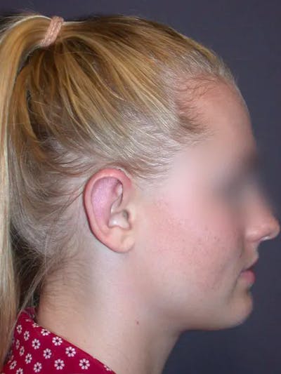 Ear Surgery Before & After Gallery - Patient 4756981 - Image 4