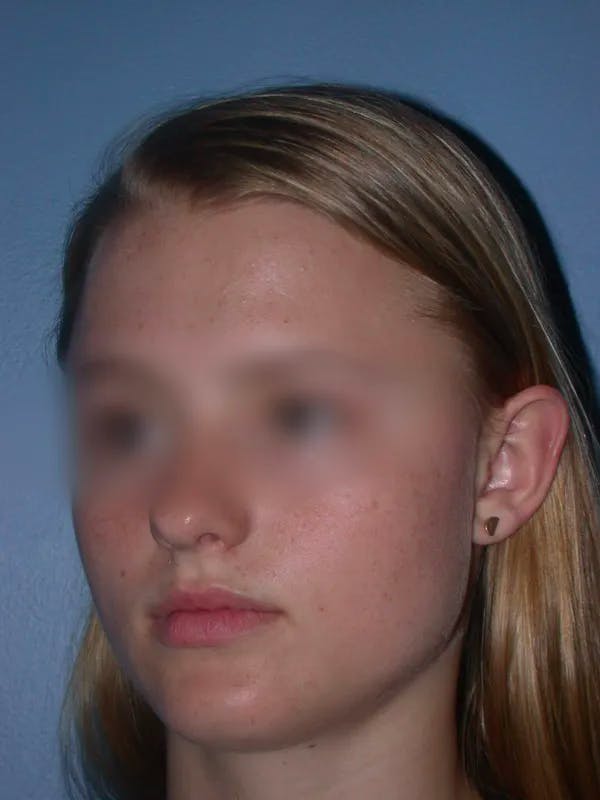 Ear Surgery Before & After Gallery - Patient 4756981 - Image 5