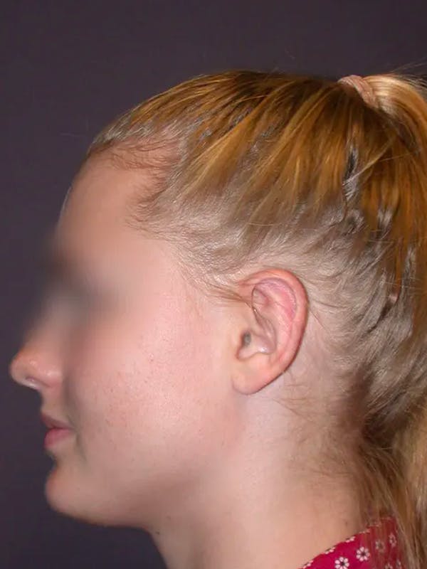 Ear Surgery Gallery Before & After Gallery - Patient 4756981 - Image 6