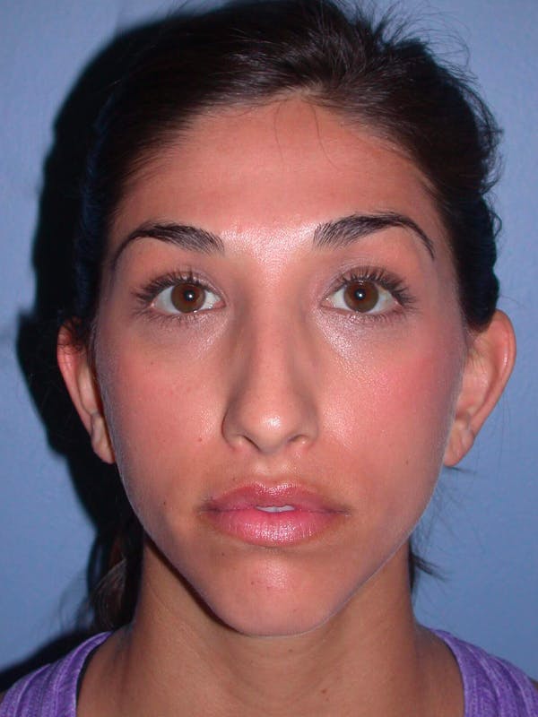Rhinoplasty Gallery Before & After Gallery - Patient 4757154 - Image 7