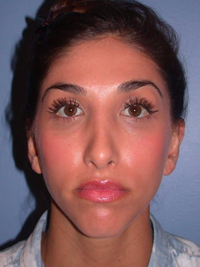 Rhinoplasty Gallery Before & After Gallery - Patient 4757154 - Image 8