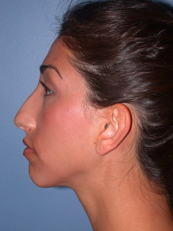 Rhinoplasty Gallery Before & After Gallery - Patient 4757154 - Image 3